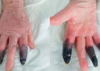 Reprodução/European Journal of Vascular and Endovascular Surgery