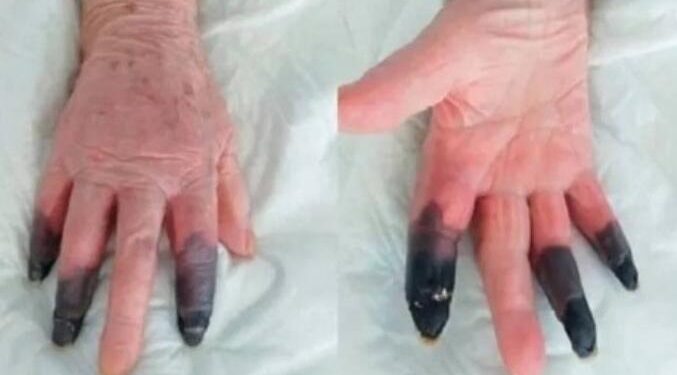 Reprodução/European Journal of Vascular and Endovascular Surgery