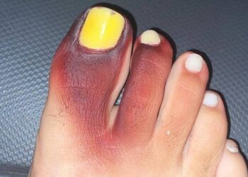 Uma necrose temporária foi dada nos dedos e as unhas ainda ficaram amareladas. Preste atenção ao calçar os sapatos! Foto: Reprodução/Agência O Globo