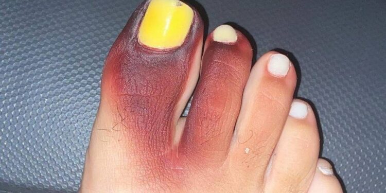 Uma necrose temporária foi dada nos dedos e as unhas ainda ficaram amareladas. Preste atenção ao calçar os sapatos! Foto: Reprodução/Agência O Globo