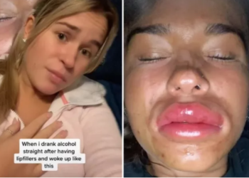 Influencer ficou com o rosto todo inchado após o procedimento. Foto: Reprodução/Internet