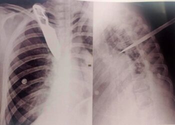 No raio-x foi possível ver a faca cravada no peito da mulher. Foto: Reprodução/Internet