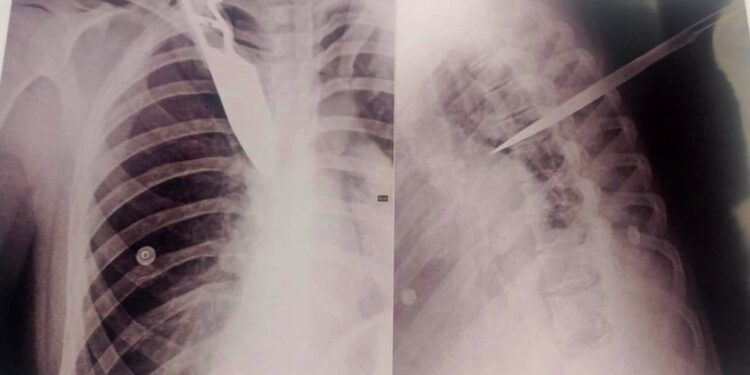 No raio-x foi possível ver a faca cravada no peito da mulher. Foto: Reprodução/Internet
