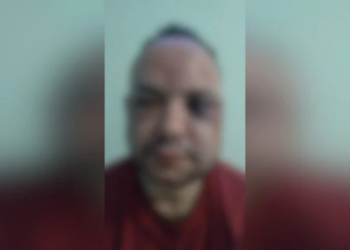 A vítima está com diversos hematomas pelo corpo. Foto: Divulgação