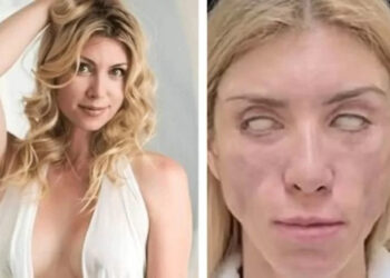 Miss disse que queria apenas corrigir alguns problemas decorrentes da idade. Foto: Divulgação