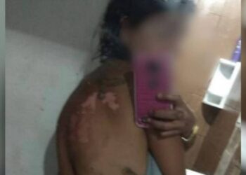 Mulher sofreu queimaduras nas costas. Homem foi preso. Foto: Reprodução