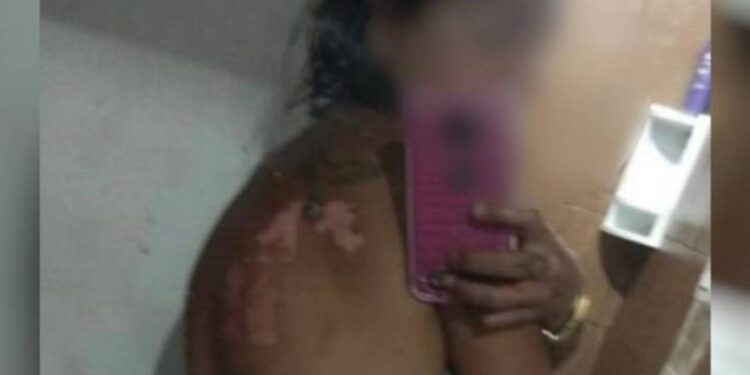 Mulher sofreu queimaduras nas costas. Homem foi preso. Foto: Reprodução