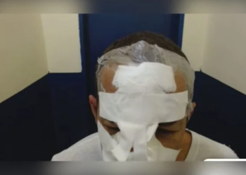 O homem teve que passar por uma reconstrução facial. Foto: Reprodução/Metrópoles