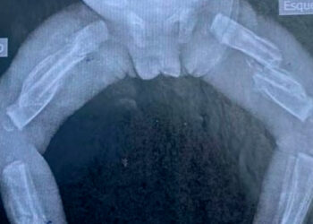 Crianaça chegou ao hospital com diversas fraturas. Foto: Reprodução