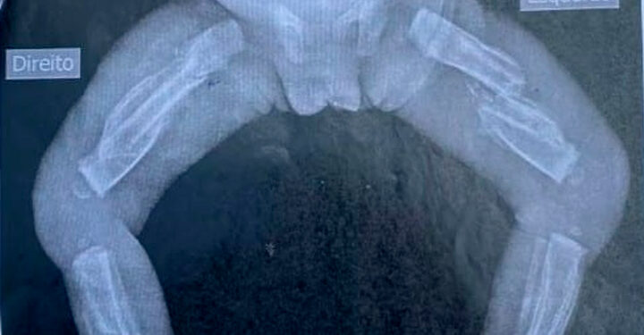 Crianaça chegou ao hospital com diversas fraturas. Foto: Reprodução