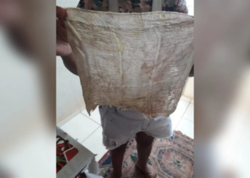 Mulher teve que ser submetida a cirurgia para a retirada do pano. Foto: Reprodução