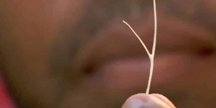 O idoso engoliu a espinha no mês passado e depois sofreu complicações com o passar dos dias. Foto: Reprodução/Internet