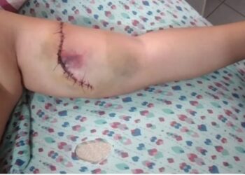 O menino ficou com a carne exposta e levou 19 pontos. Foto: Reprodução