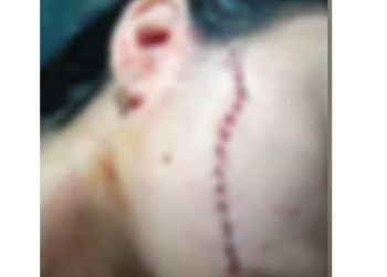 A menina teve um corte profundo e levou vários pontos. Foto: Reprodução