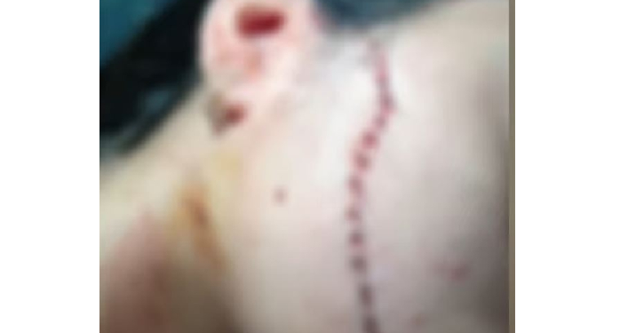 A menina teve um corte profundo e levou vários pontos. Foto: Reprodução