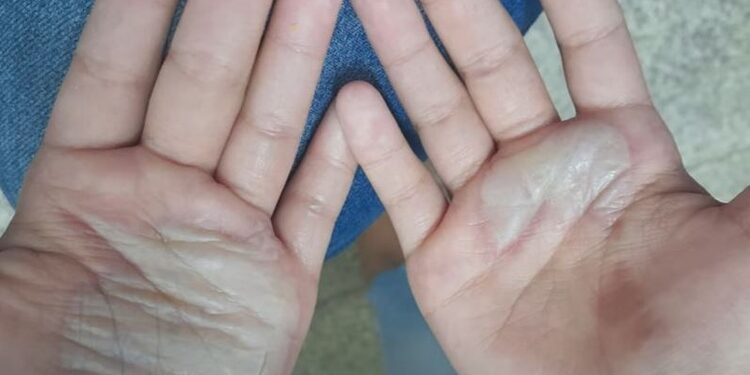 As bolhas confirmaram a agressão. Foto: Reprodução