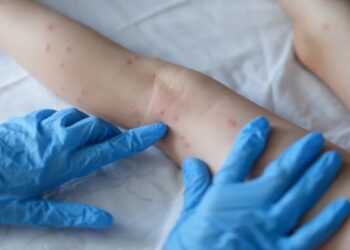 O paciente é um homem que está em isolamento e se recuperando em casa. Foto: Reprodução/Internet