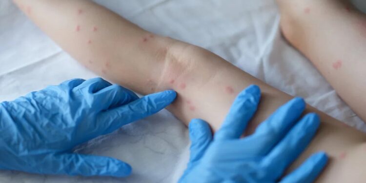 O paciente é um homem que está em isolamento e se recuperando em casa. Foto: Reprodução/Internet
