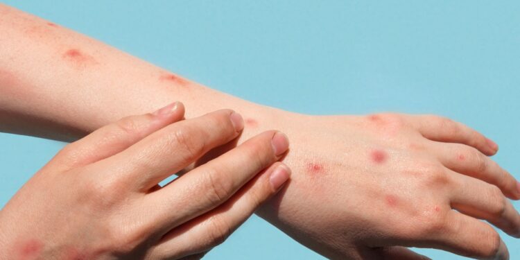 O Amazonas já tem uma confirmação e investiga outros dois casos. Foto: Reprodução