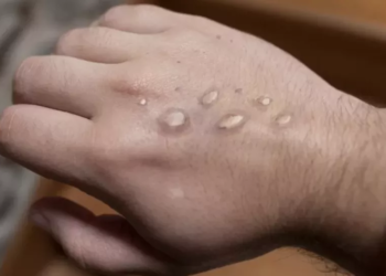 Os pacientes tiveram material coletado. Foto: Reprodução