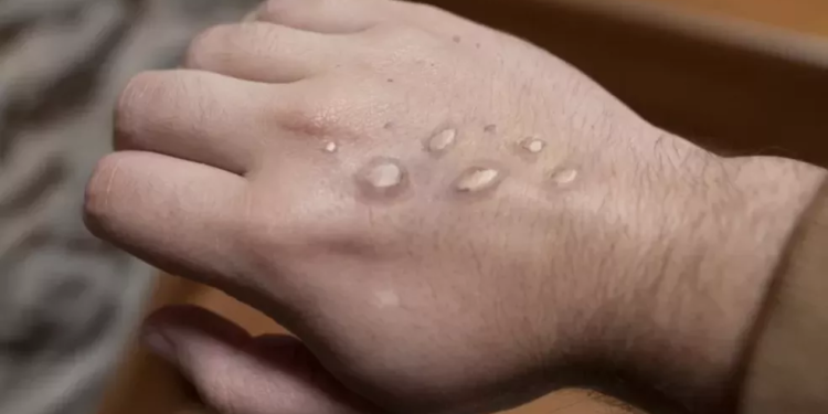 Os pacientes tiveram material coletado. Foto: Reprodução