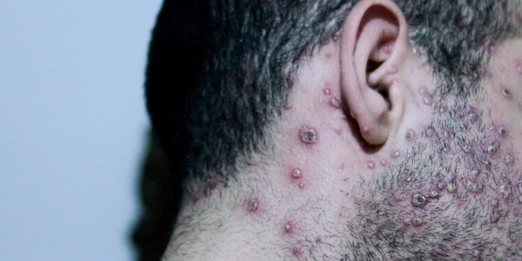 A doença lembra muito a catapora. Foto: Adra Assessoria/Reprodução