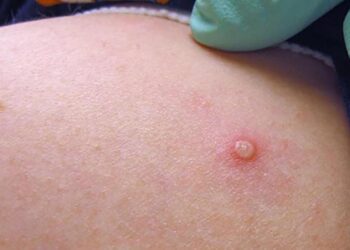 Esse é o primeiro caso em uma mulher, no AM. Foto: Reprodução/Internet