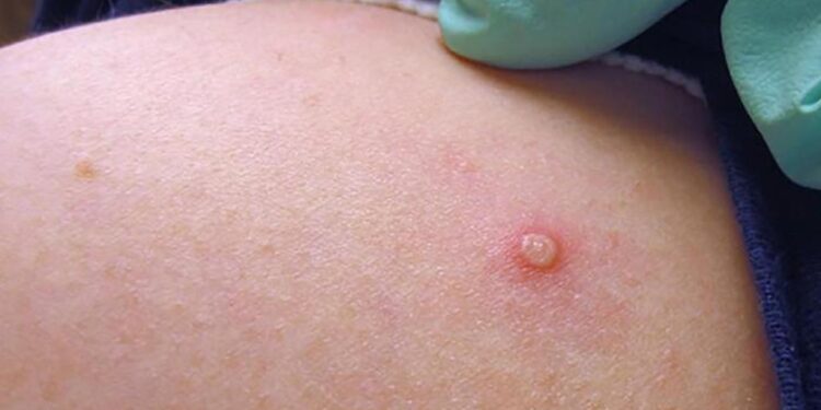 Esse é o primeiro caso em uma mulher, no AM. Foto: Reprodução/Internet