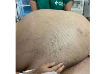 Só de tumor eram 46 kg. Foto: Reprodução