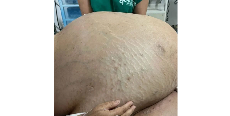 Só de tumor eram 46 kg. Foto: Reprodução