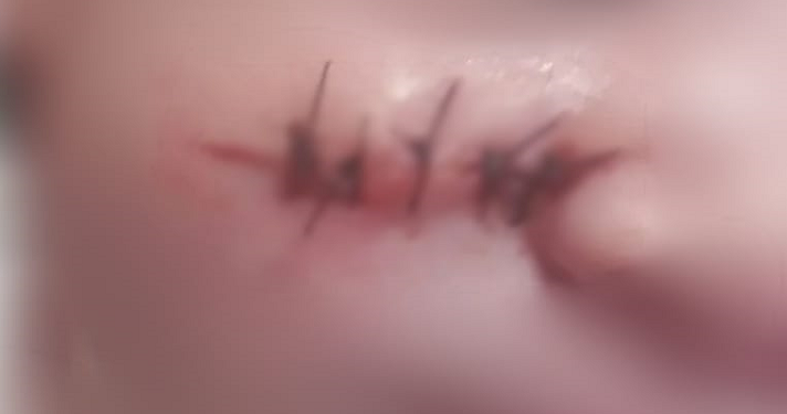 Atualmente a criança, uma menina, tem 3 meses e ficou com cicatriz. Foto: Reprodução