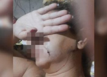 A mulher teve que passar por cirurgia. Foto: Reprodução