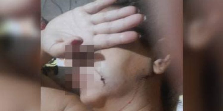 A mulher teve que passar por cirurgia. Foto: Reprodução