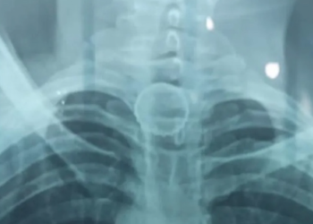 A tampa ficou presa no esôfago. Foto: Reprodução