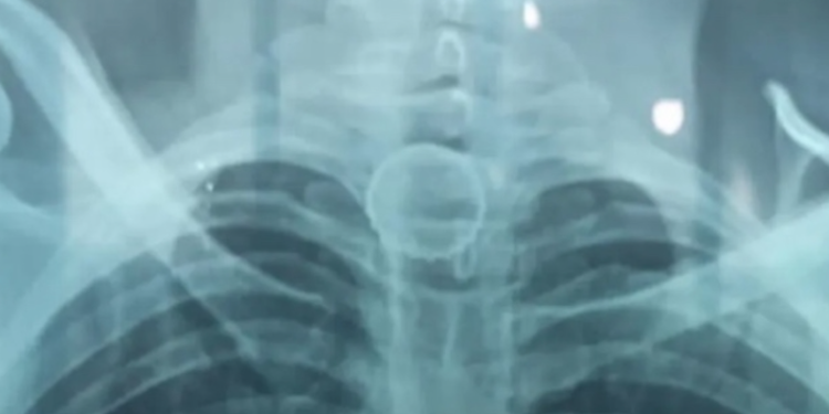 A tampa ficou presa no esôfago. Foto: Reprodução