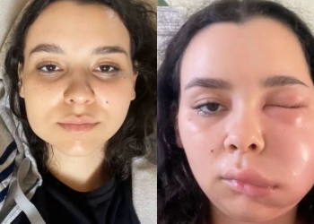 Ana Luiza disse que após o procedimento, na madrugada, as dores foram aumento e ficando insuportáveis. Foto: Reprodução