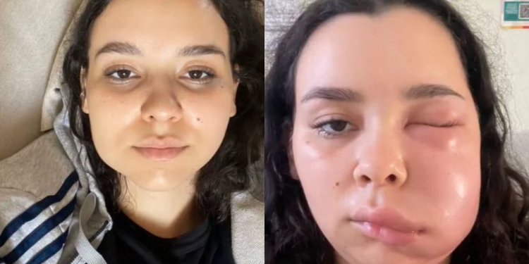 Ana Luiza disse que após o procedimento, na madrugada, as dores foram aumento e ficando insuportáveis. Foto: Reprodução