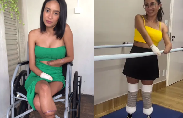 A jovem acabou tendo uma infecção generalizada e perdeu os membros. Foto: Reprodução