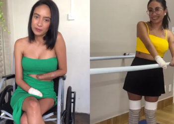 A jovem acabou tendo uma infecção generalizada e perdeu os membros. Foto: Reprodução