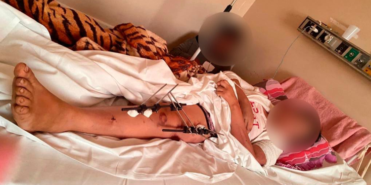 A mulher foi identificada e passou por diversas cirurgias. Foto: Reprodução