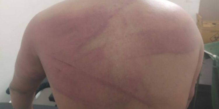 Piratas do rio deixam ribeirinho cheio de hematomas em sessão se tortura no Amazonas