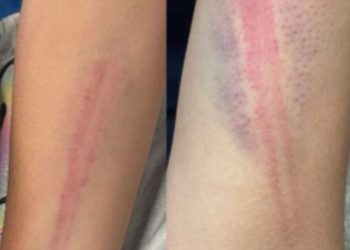 Mãe e padrasto que deixaram a filha com os braços cheios de hematomas são presos em Manaus