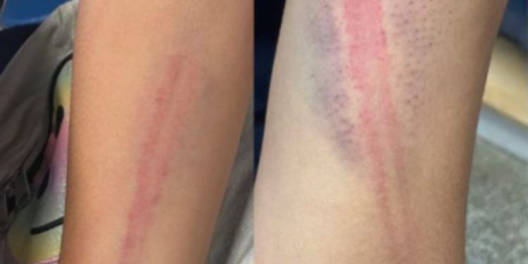 Mãe e padrasto que deixaram a filha com os braços cheios de hematomas são presos em Manaus