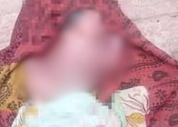 Veja a foto do bebê que nasceu com quatro pernas, quatro braços e dois rostos