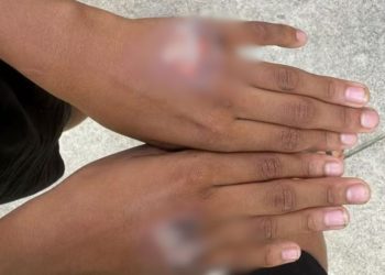 Mãe queima o filho com chapinha de cabelo como punição por ele ter comido iogurte sem permissão