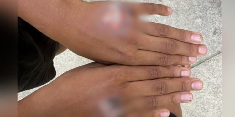 Mãe queima o filho com chapinha de cabelo como punição por ele ter comido iogurte sem permissão