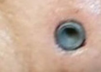 Cabeça dura? Imagem impressionante mostra homem que sobreviveu após levar tiro na testa