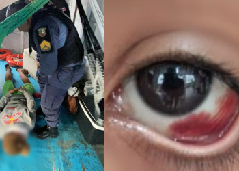 A menina acordou sendo enforcada, tendo uma hemorragia ocular. Foto: Divulgação/PC-AM