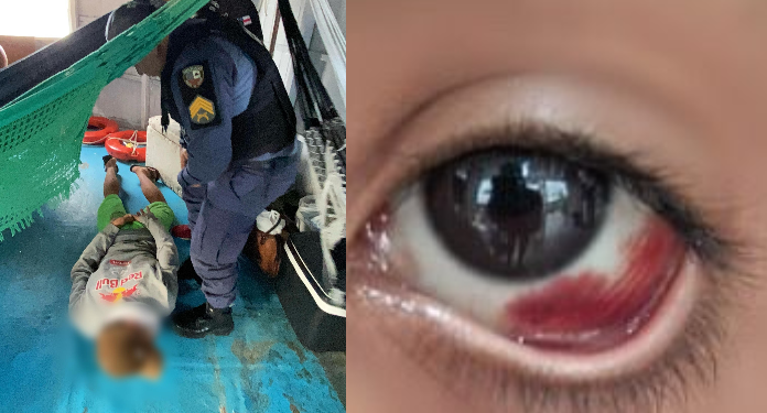 A menina acordou sendo enforcada, tendo uma hemorragia ocular. Foto: Divulgação/PC-AM