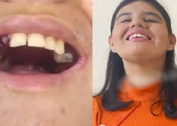A jovem sempre é sedada para os procedimentos e ia regularmente ao dentista. Foto: Reprodução